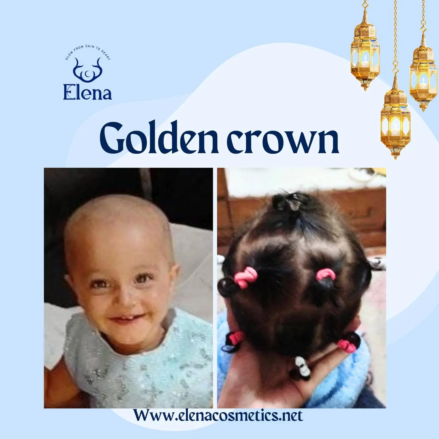 Before and after photos of a baby girl showing impressive hair growth results after using Elena Cosmetics’ Golden Crown Hair Oil – from bald to full head of healthy hair.
