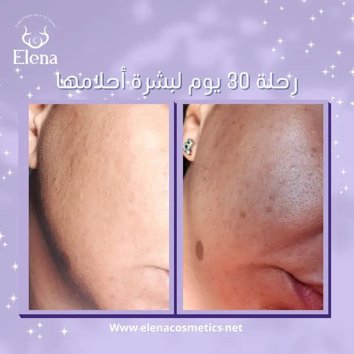 Visible skin texture improvement after 30 days of using Elena Cosmetics – smoother cheeks and more refined pores.