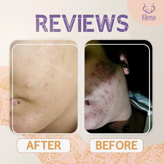 Visible fading of acne scars and redness after using Elena Cosmetics' oily skin kit – real customer review.