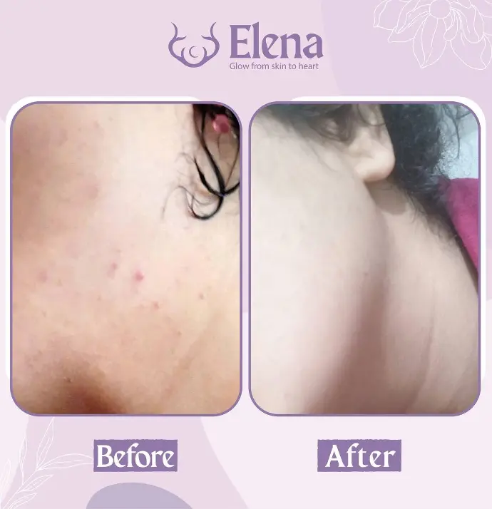 Before and after using Elena Cosmetics’ oily skin kit – clearer skin and reduced breakouts on jawline.