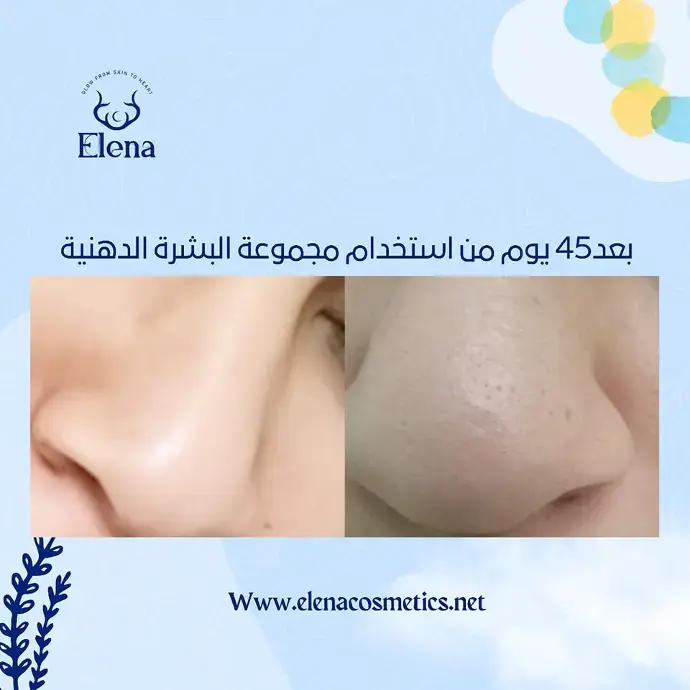 Before and after 45 days of using Elena Cosmetics' oily skin routine – visible reduction in pores and shine around the nose area.