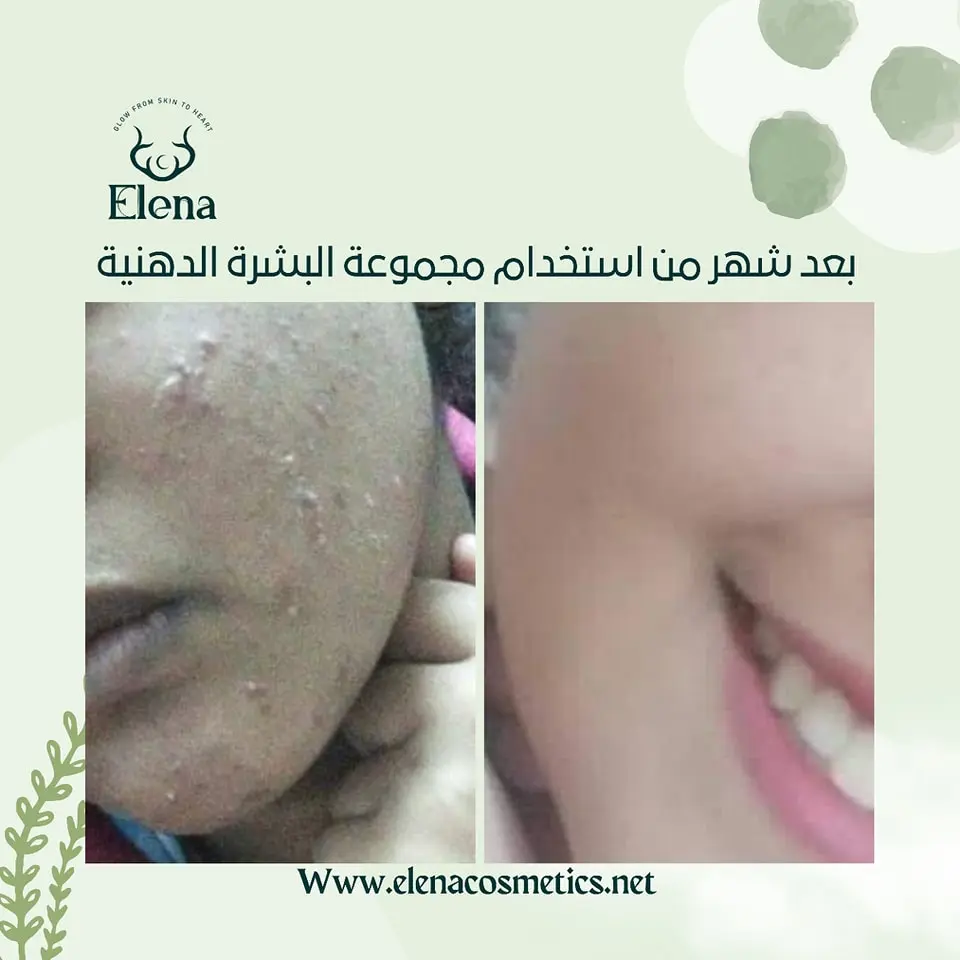 Before and after one month of using Elena Cosmetics' oily skin kit – visible acne reduction on a dark-skinned woman.