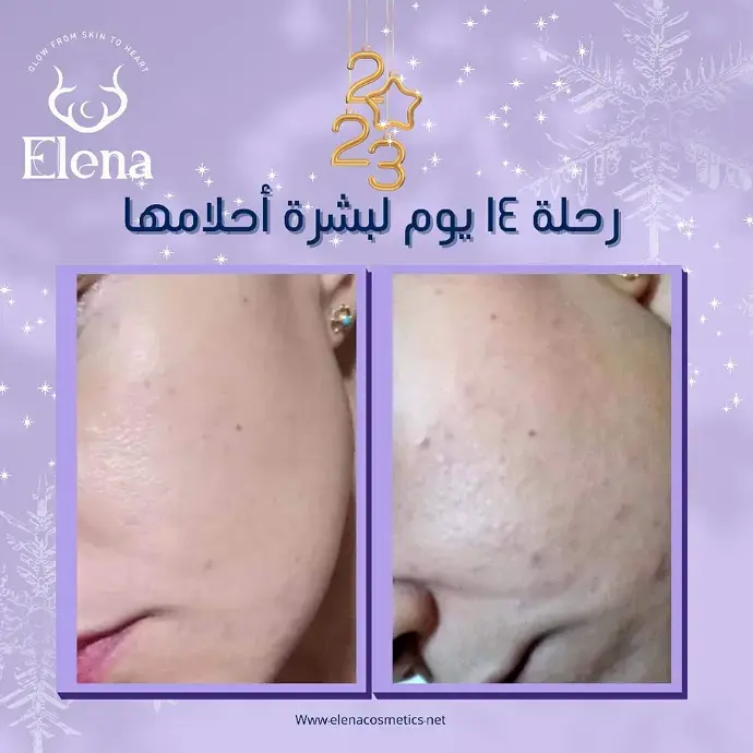 Skin texture and clarity improvement after 14 days of using Elena Cosmetics skincare routine – side cheek view.